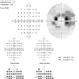 Plaquenil Toxicity